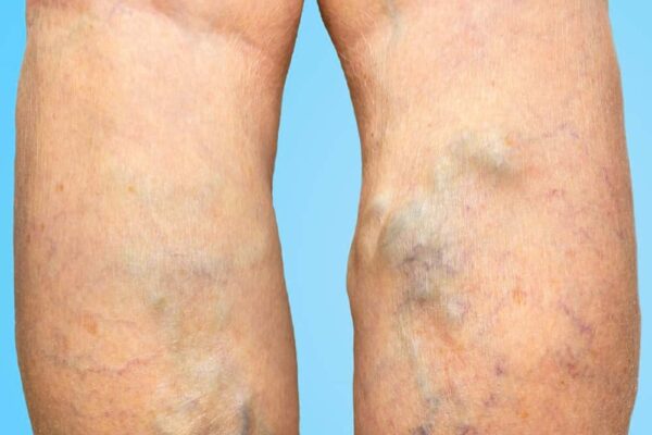 Looking for a Varicose Veins Doctor Near Me? Trusted Local Clinics vericose veins