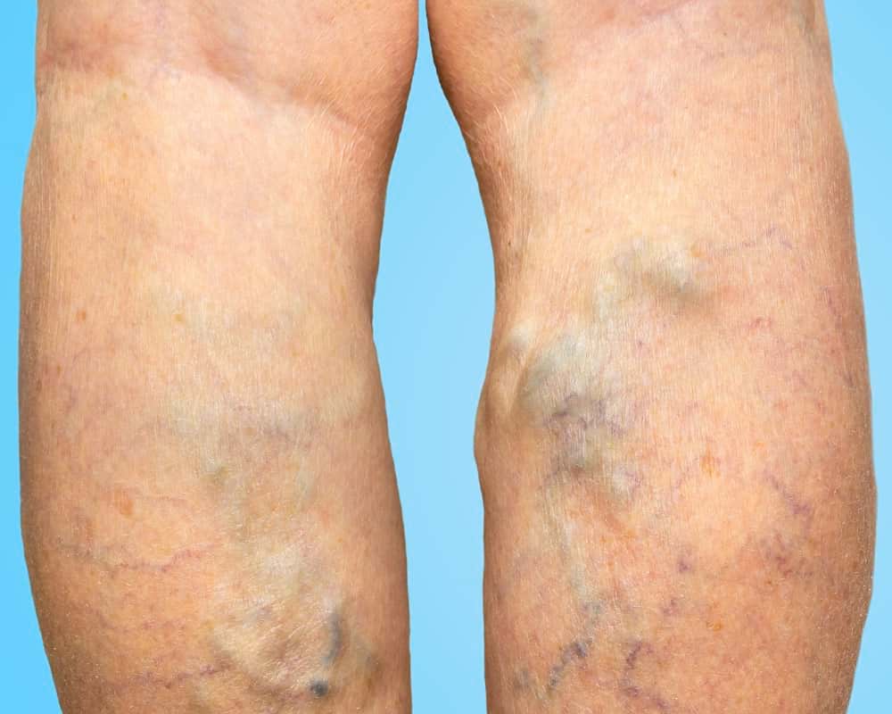 vericose veins