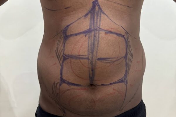 Nose Plastic Surgery in Personiks | Nose Beauty Surgery Experts