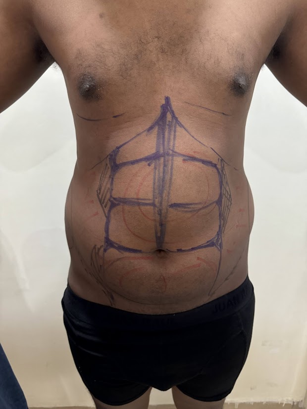 Nose Plastic Surgery in Personiks | Nose Beauty Surgery Experts