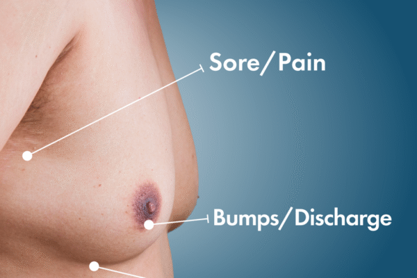 gynecomastia in islamabad