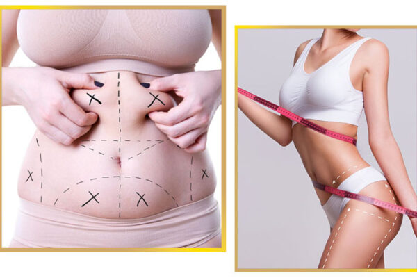 liposuction in islamabad